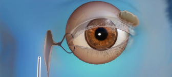 Endoscopic Sinus Surgery Malad