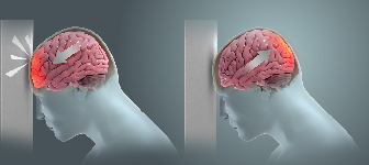 FESS Surgery Image 1