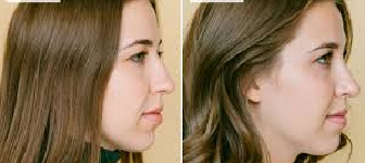 FESS Surgery Image 1