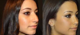 Endoscopic Sinus Surgery Malad